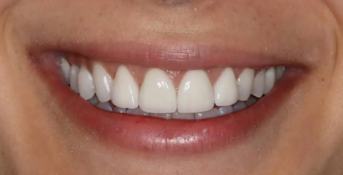 After: Anterior Veneers — Minimal Prep