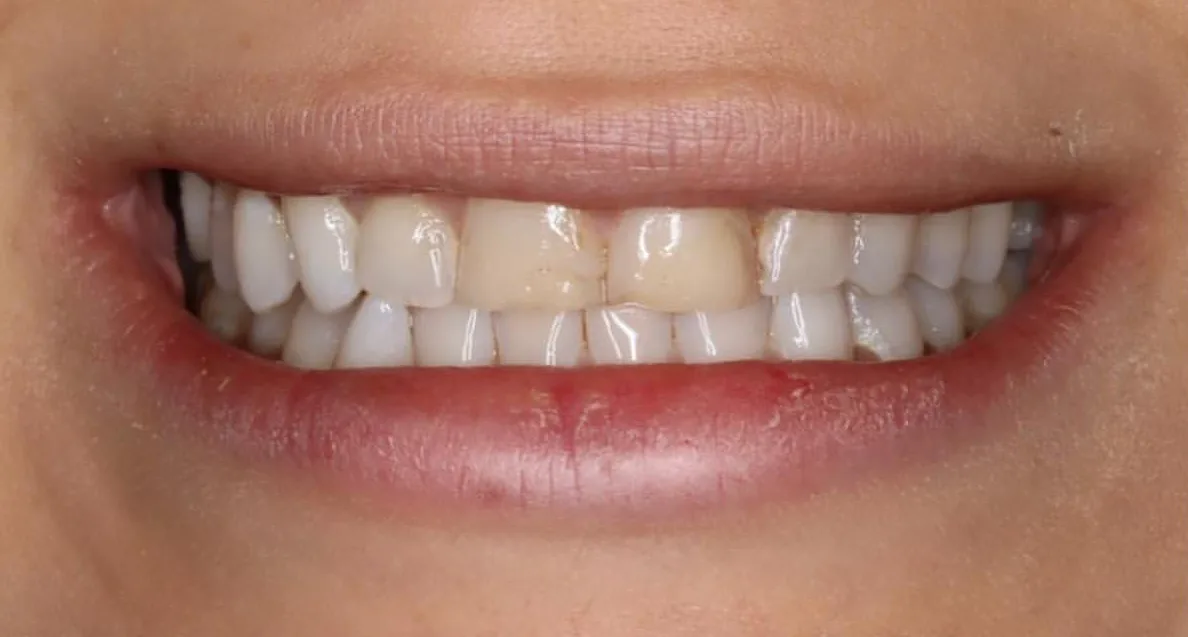 Before: Anterior Veneers — Minimal Prep