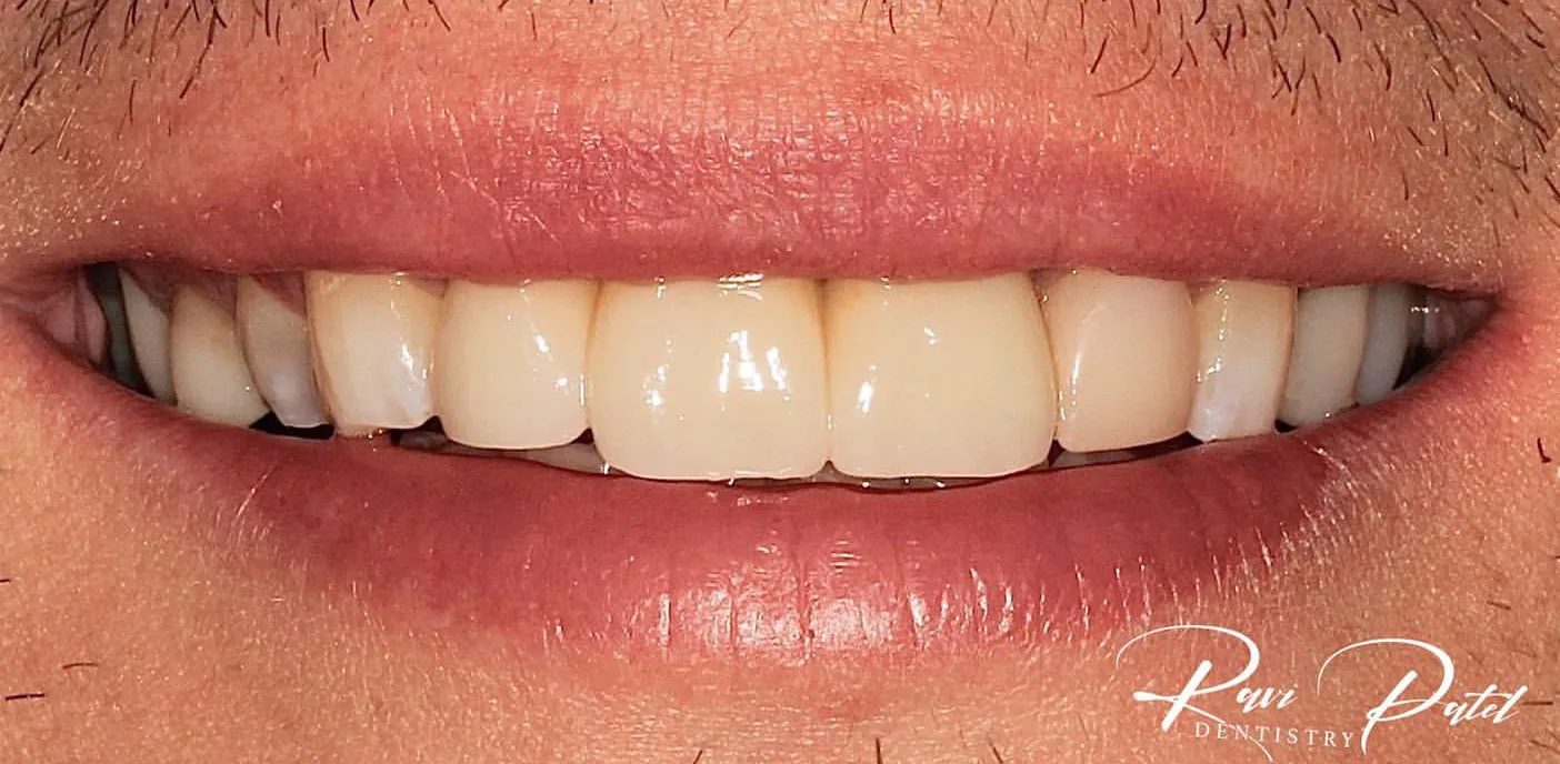 After: Central Incisor Bridge