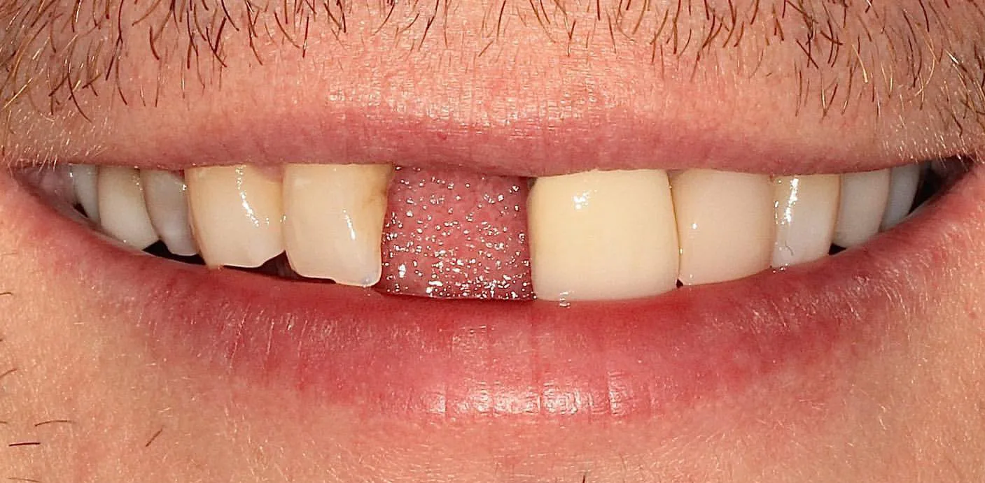 Before: Central Incisor Bridge