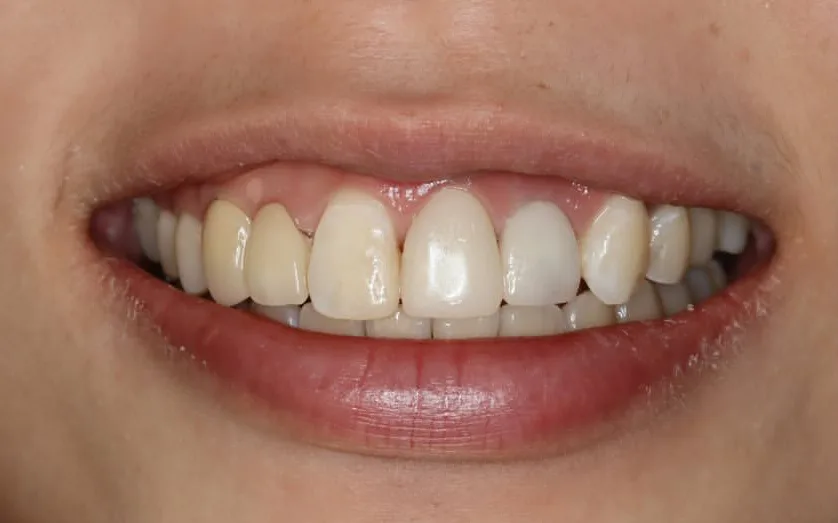 Before: Crown, Bridge & Veneers