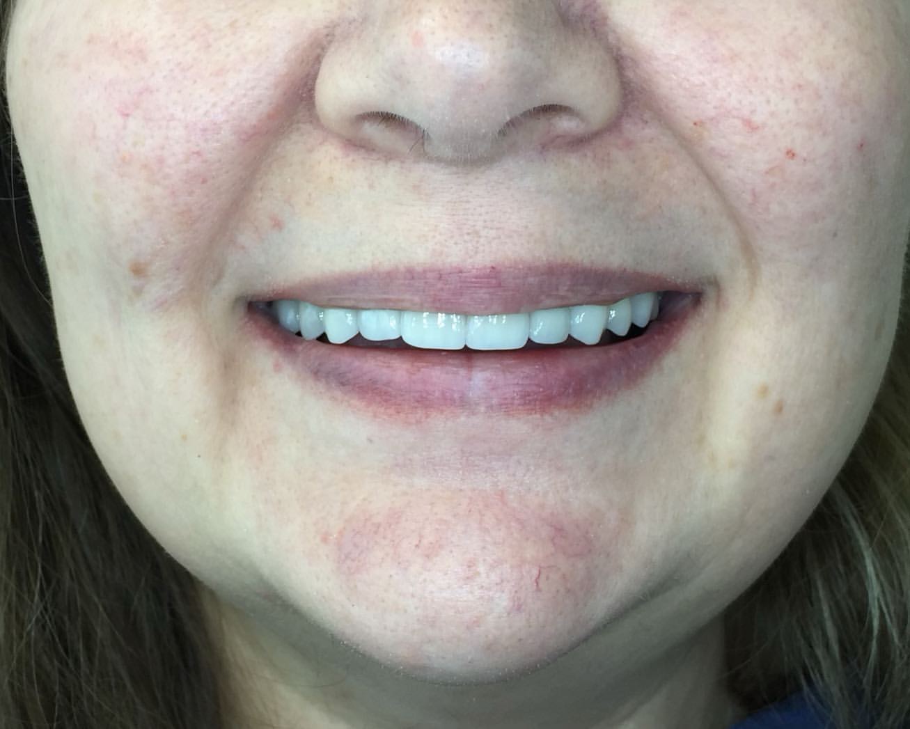 After: Full Mouth Rehabilitation