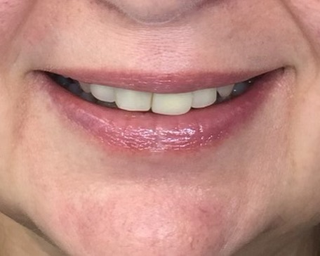 Before: Full Mouth Rehabilitation