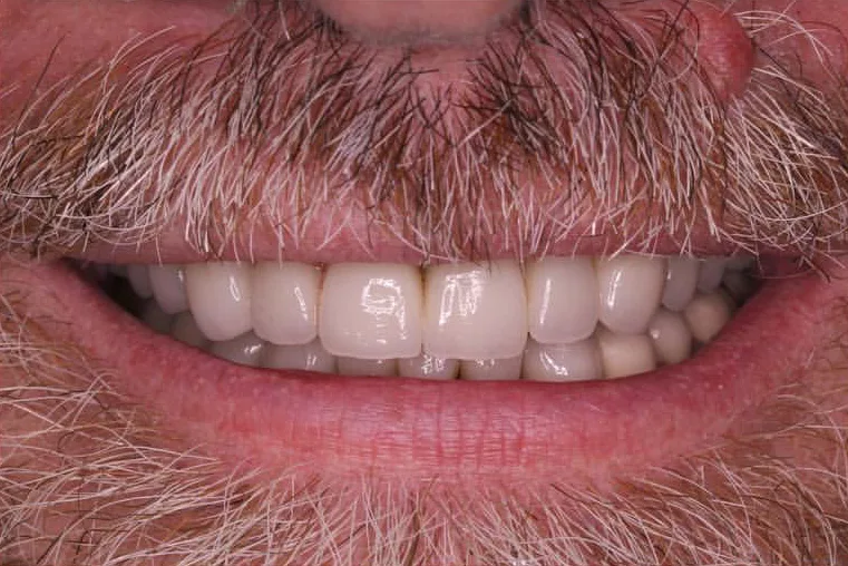 After: Mouth Rehabilitation