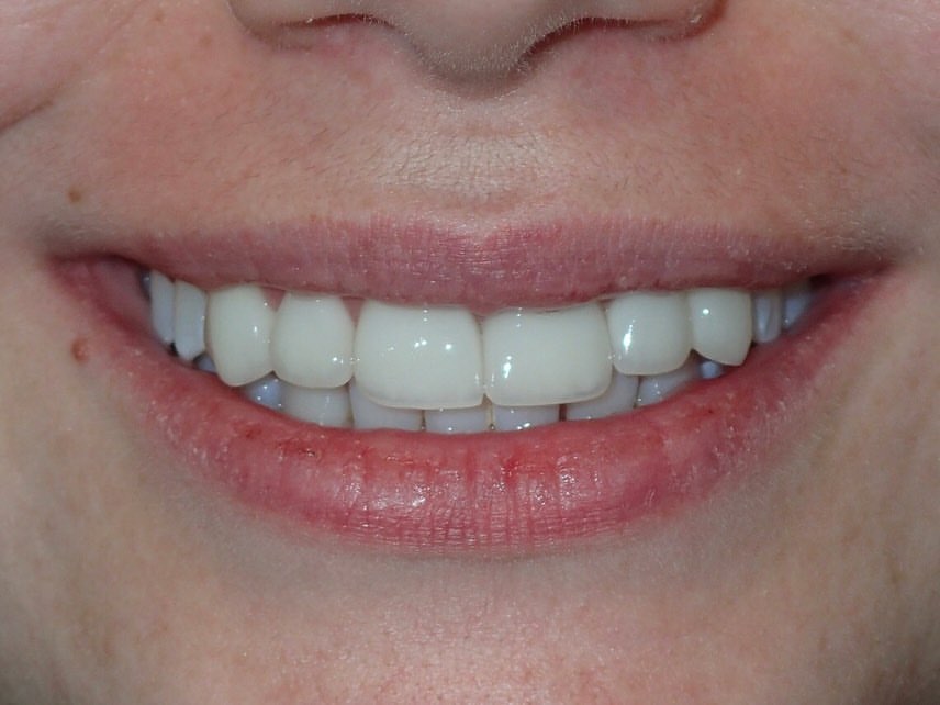 After: Implant & Five Veneers