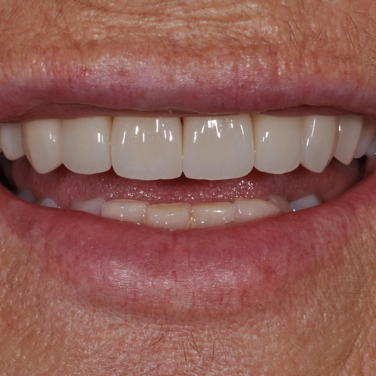 After: Anterior Veneers