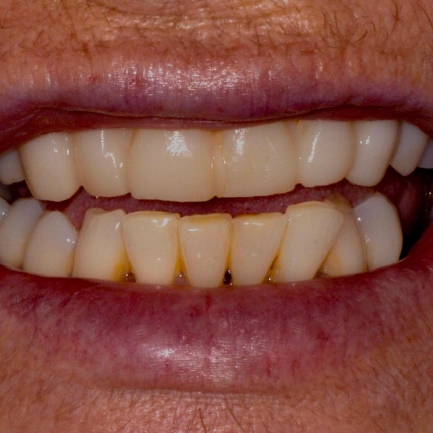 Before: Anterior Veneers